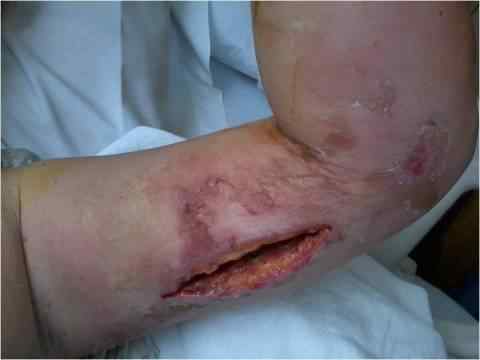 Dr. Crew's Treatment with NeutroPhase