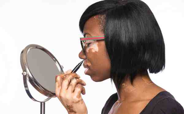 New Camouflage Solution for People with Vitiligo