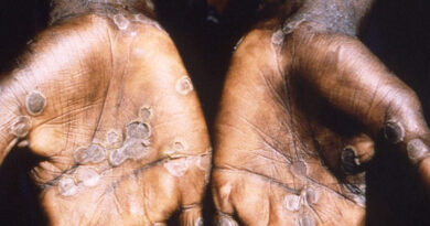 Monkeypox lesions often appear on the palms of hands. Photo: UN / CDC