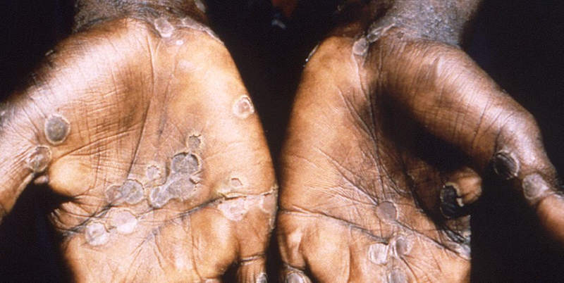 Monkeypox lesions often appear on the palms of hands. Photo: UN / CDC