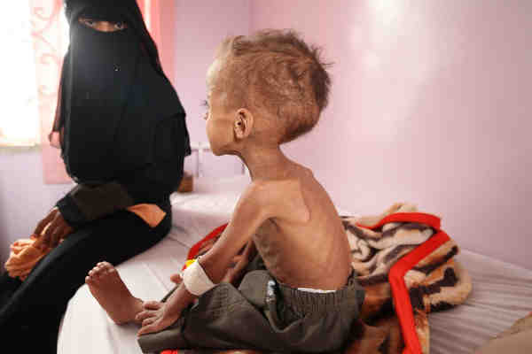 Faisal, 18 months old is treated for severe acute malnutrition at Sabeen hospital in Yemen’s capital Sana’a. Photo: UNICEF/Yasin
